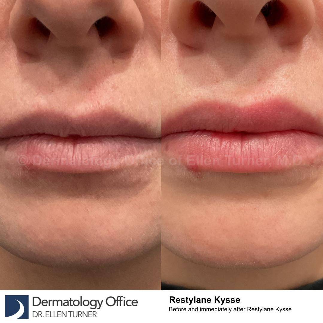 Restylane Before and After Case 17 