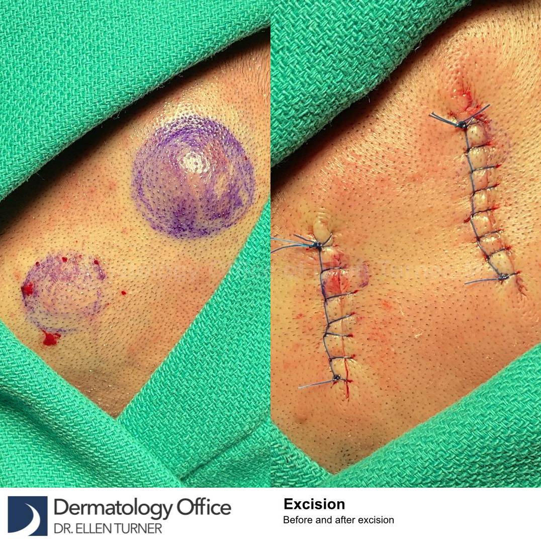 Cyst Removal Before and After Case-50 
