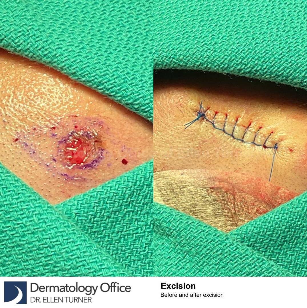 Skin Cancer (Excision) Case-87 