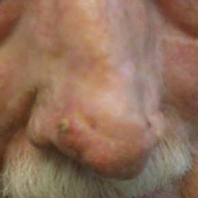 Skin Cancer Before and After Case 5 Before