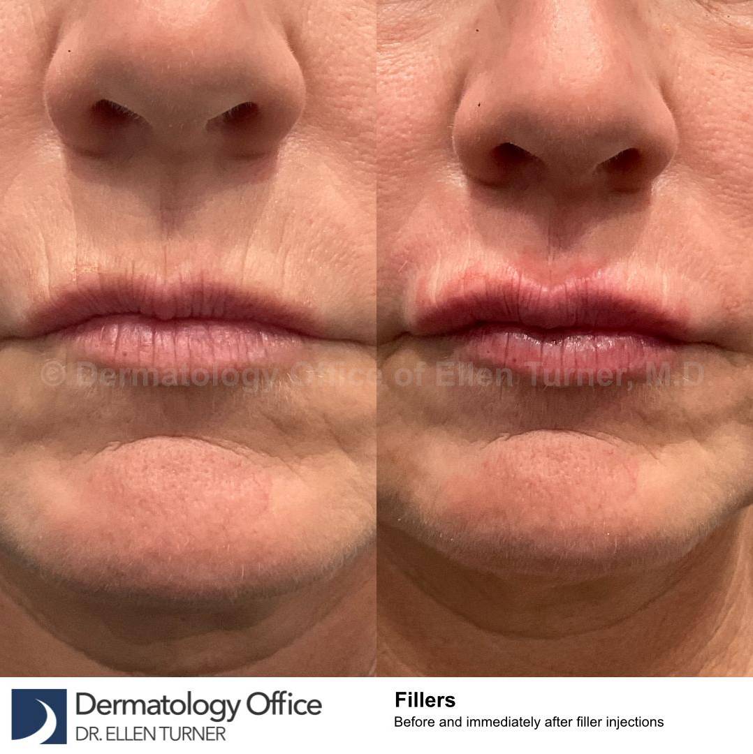 Restylane Before and After Case 23 