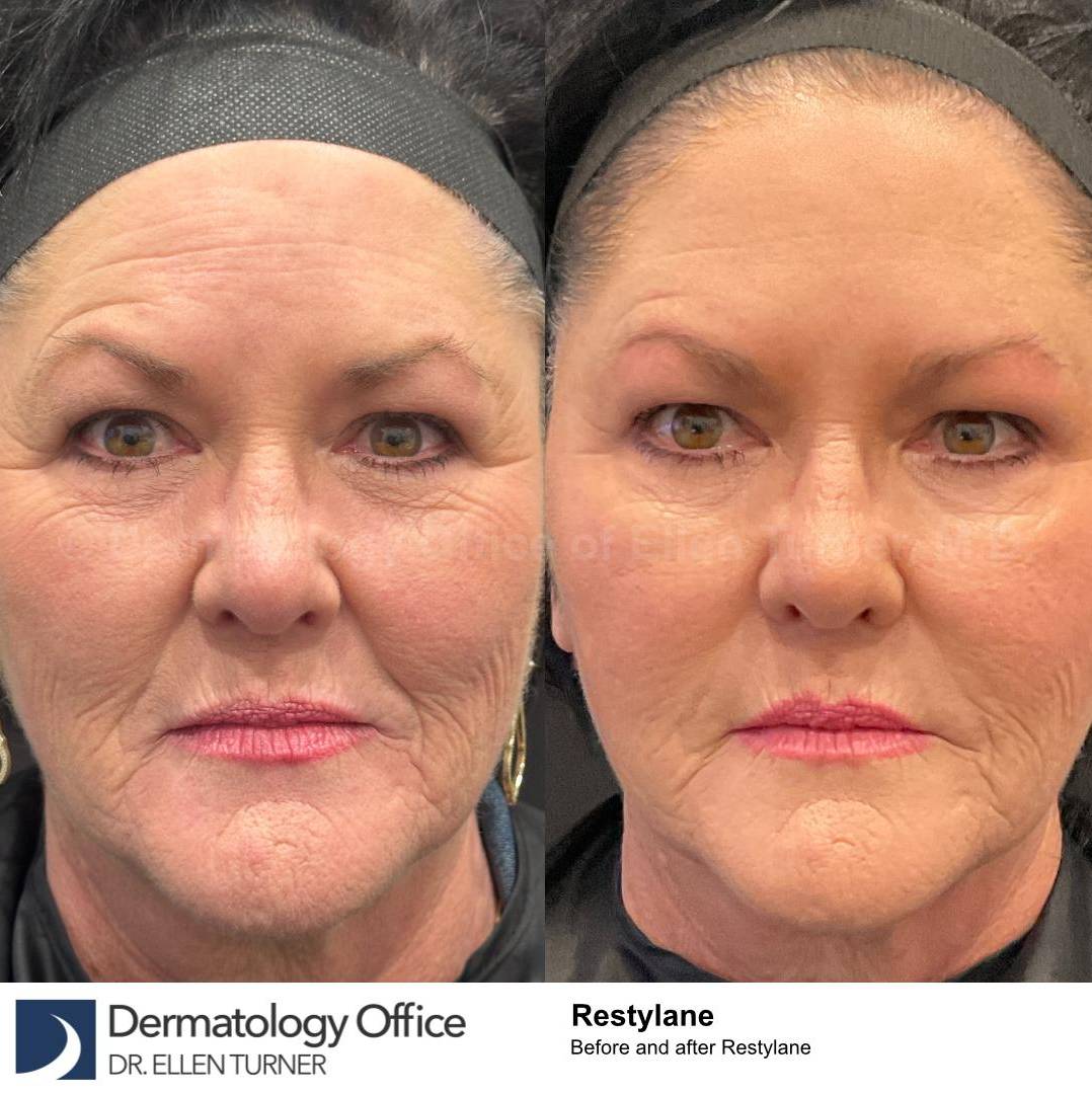 Restylane Before and After Case 18 