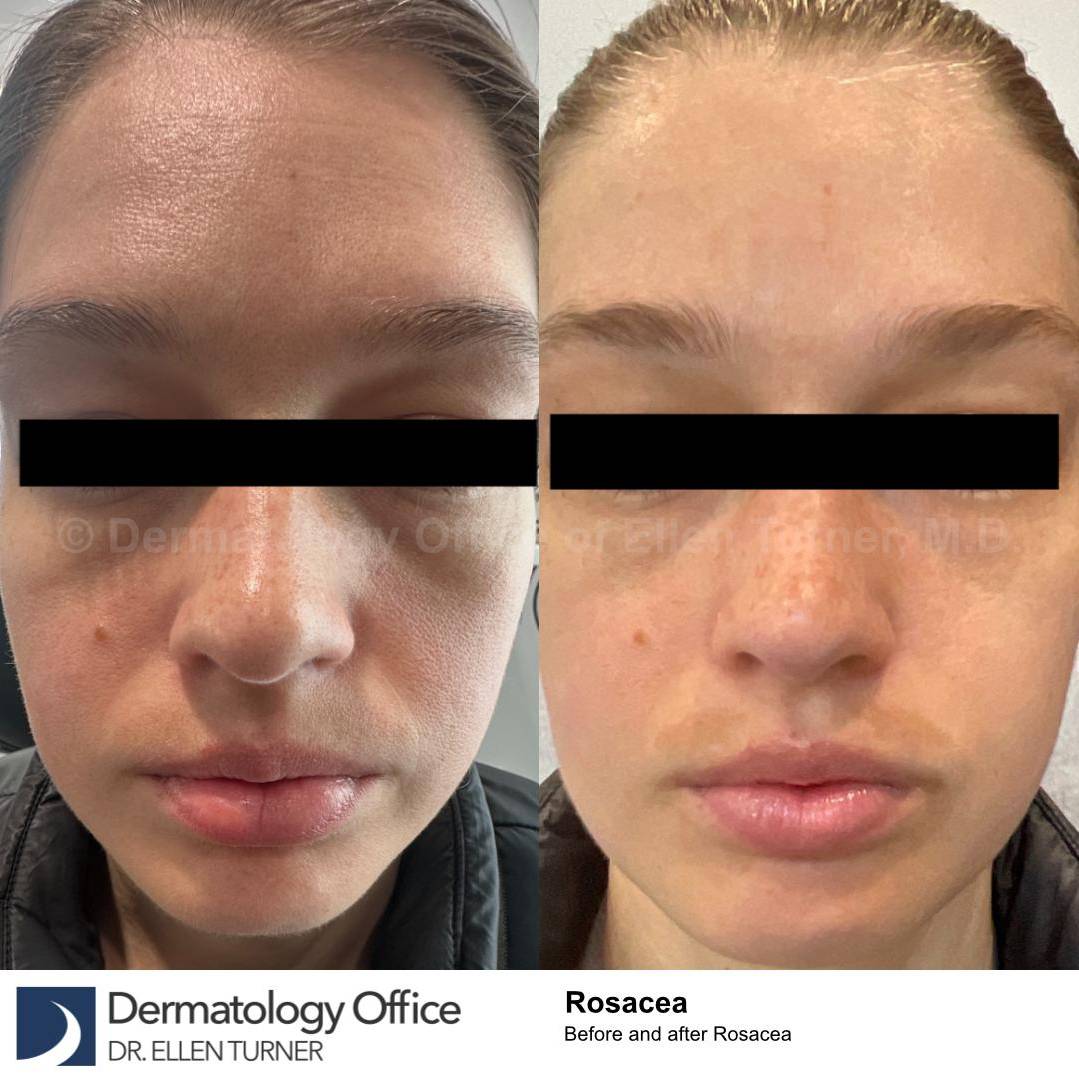 Rosacea Before and After Case-15 