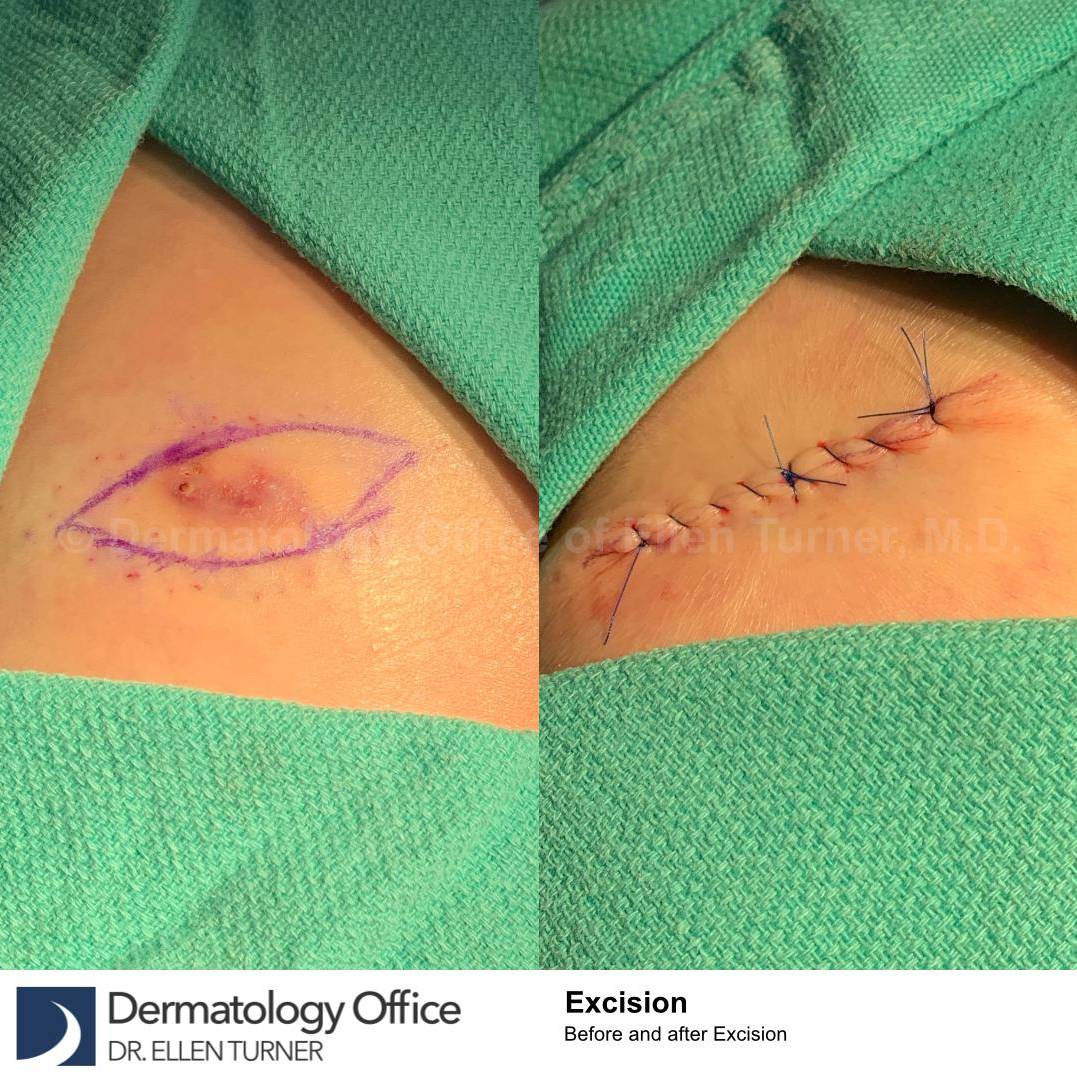 Skin Cancer (Excision) Case-88 