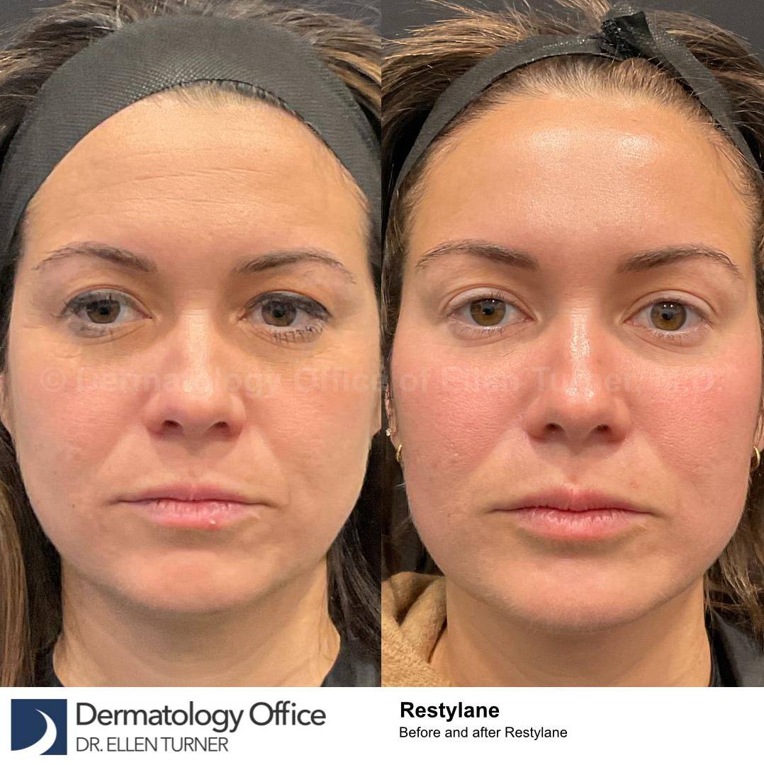 Restylane Before and After Case 19 