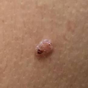 Skin Cancer Before and After Case 6 Before