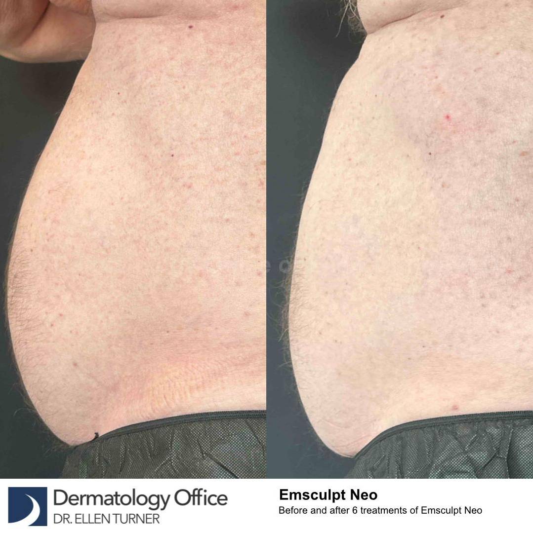 EMSculpt Neo (6 Treatments) Case-6 
