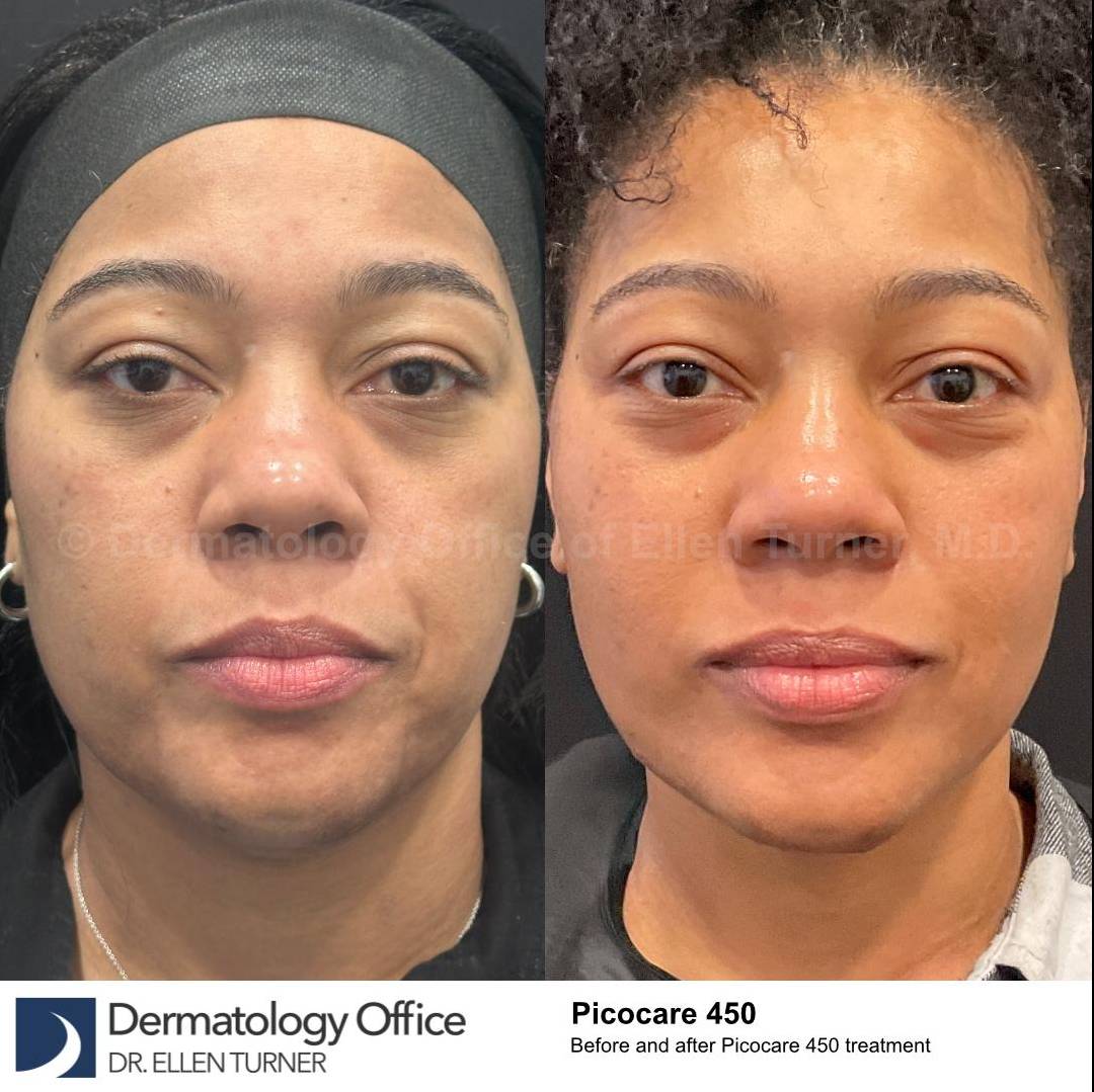 Picocare 450 Before and After Case-7 