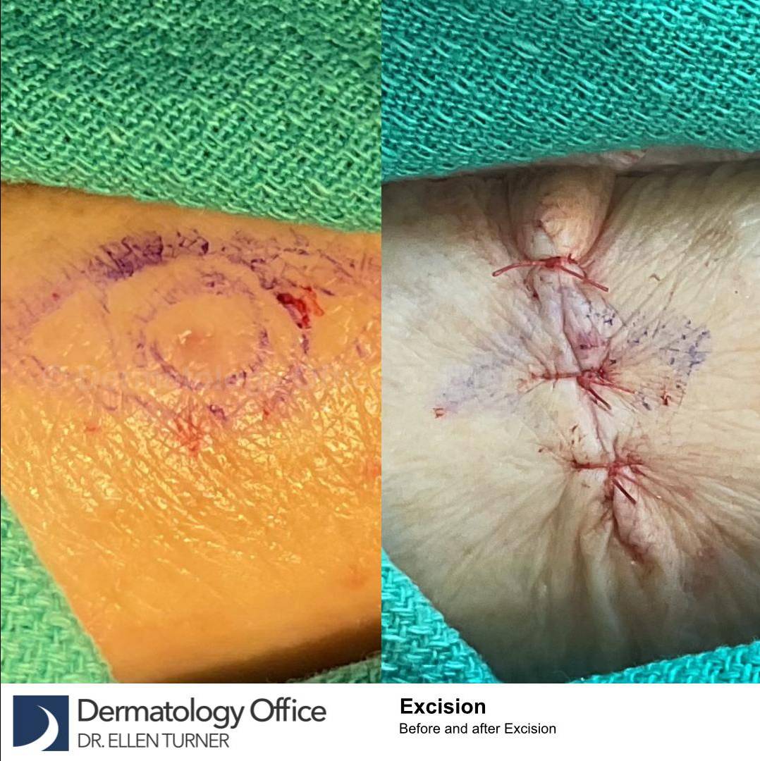 Skin Cancer (Excision) Case-89 