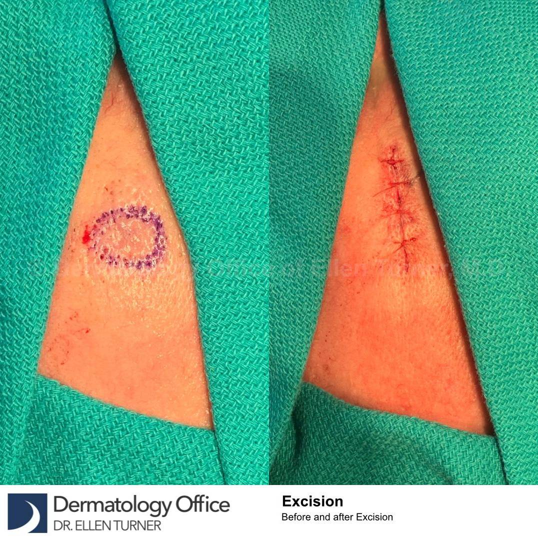Skin Cancer (Excision) Case-90 