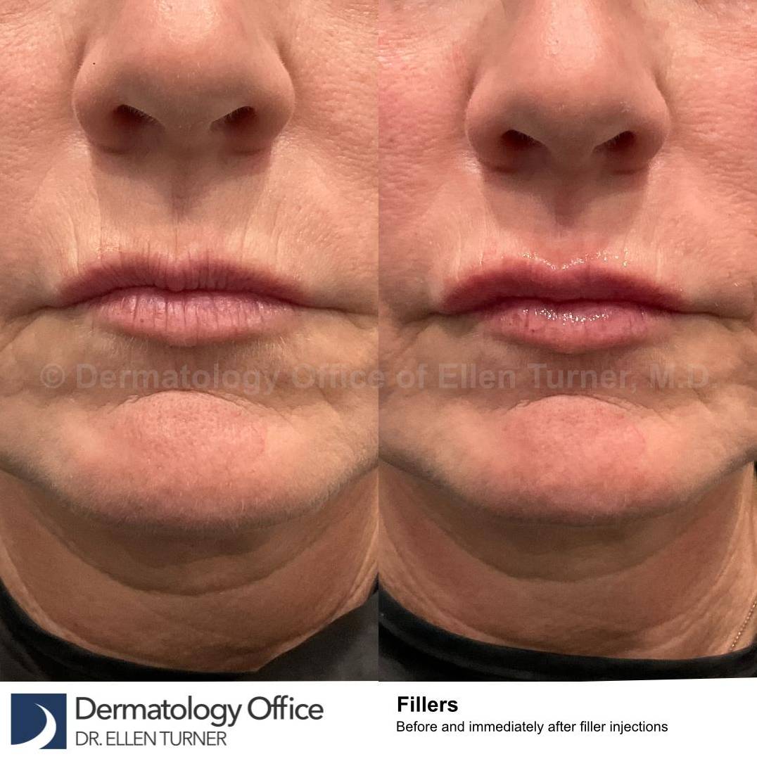 Restylane Before and After Case 24 