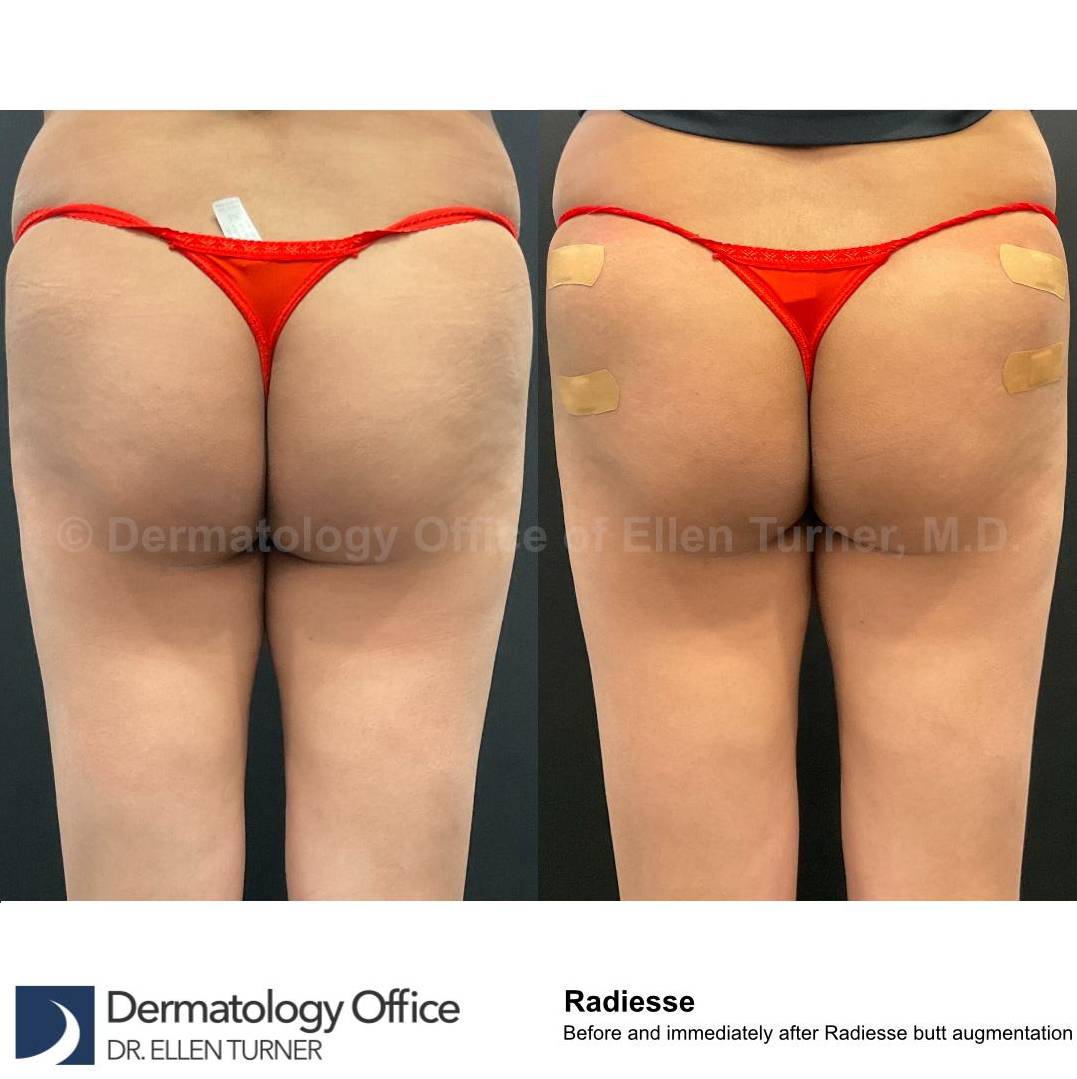 Radiesse Before and After Case 17 