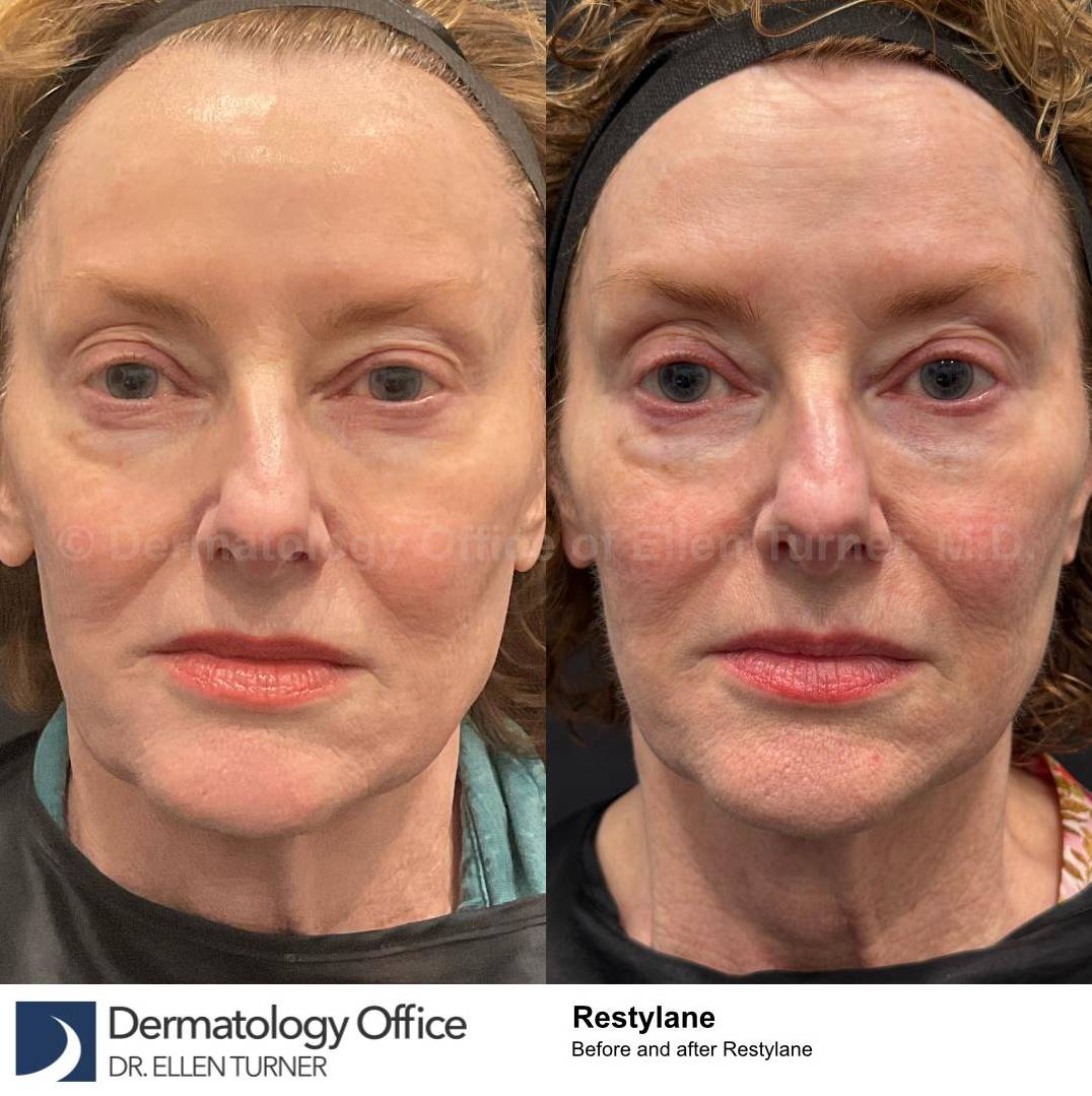 Restylane Before and After Case 20 