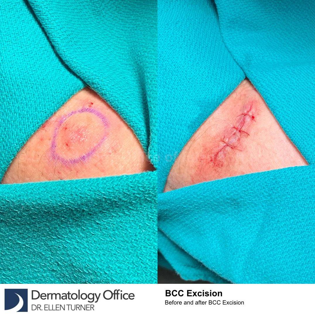 Skin Cancer (Excision) Case-91 
