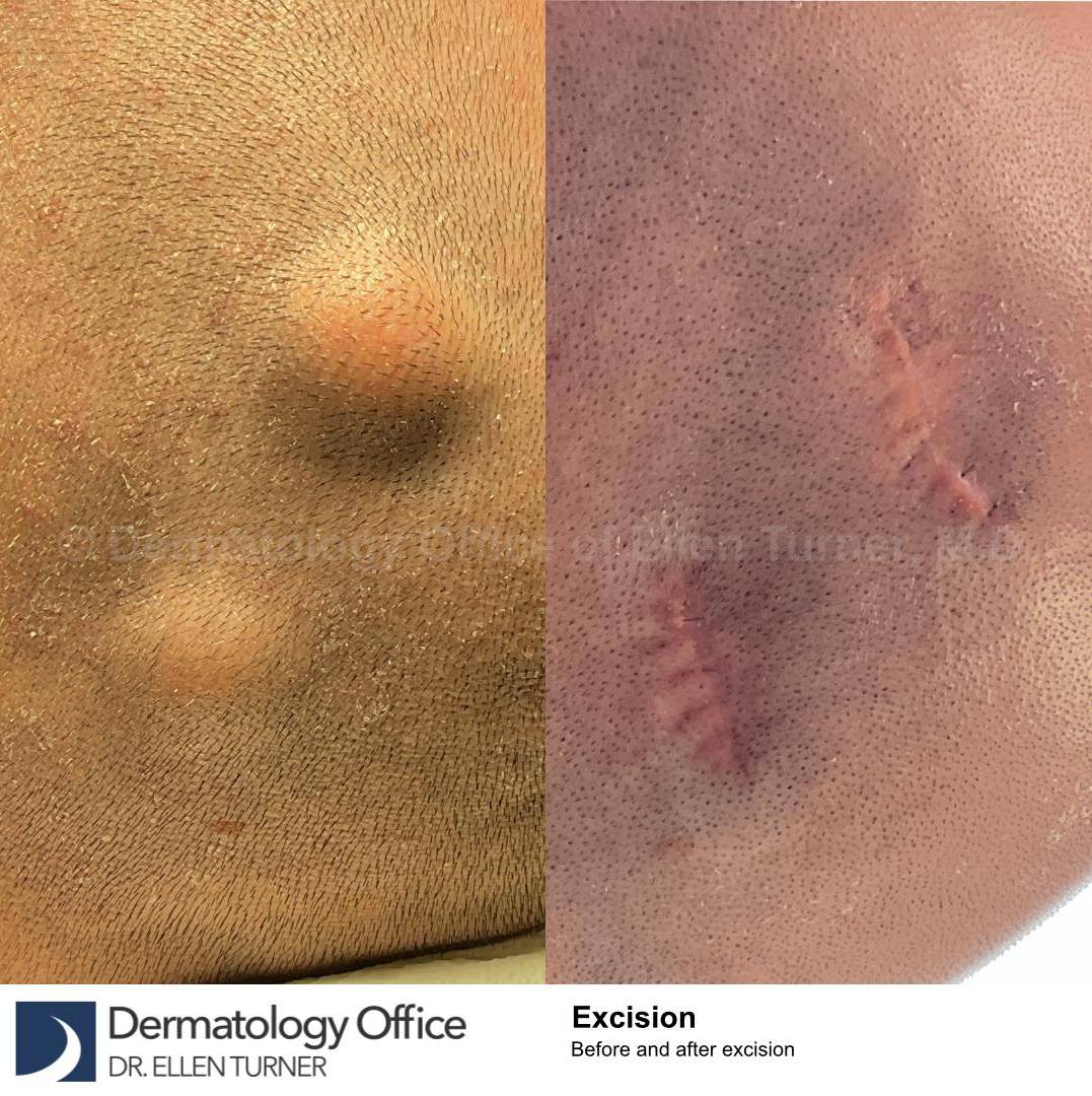 Cyst Removal Before and After Case-51 