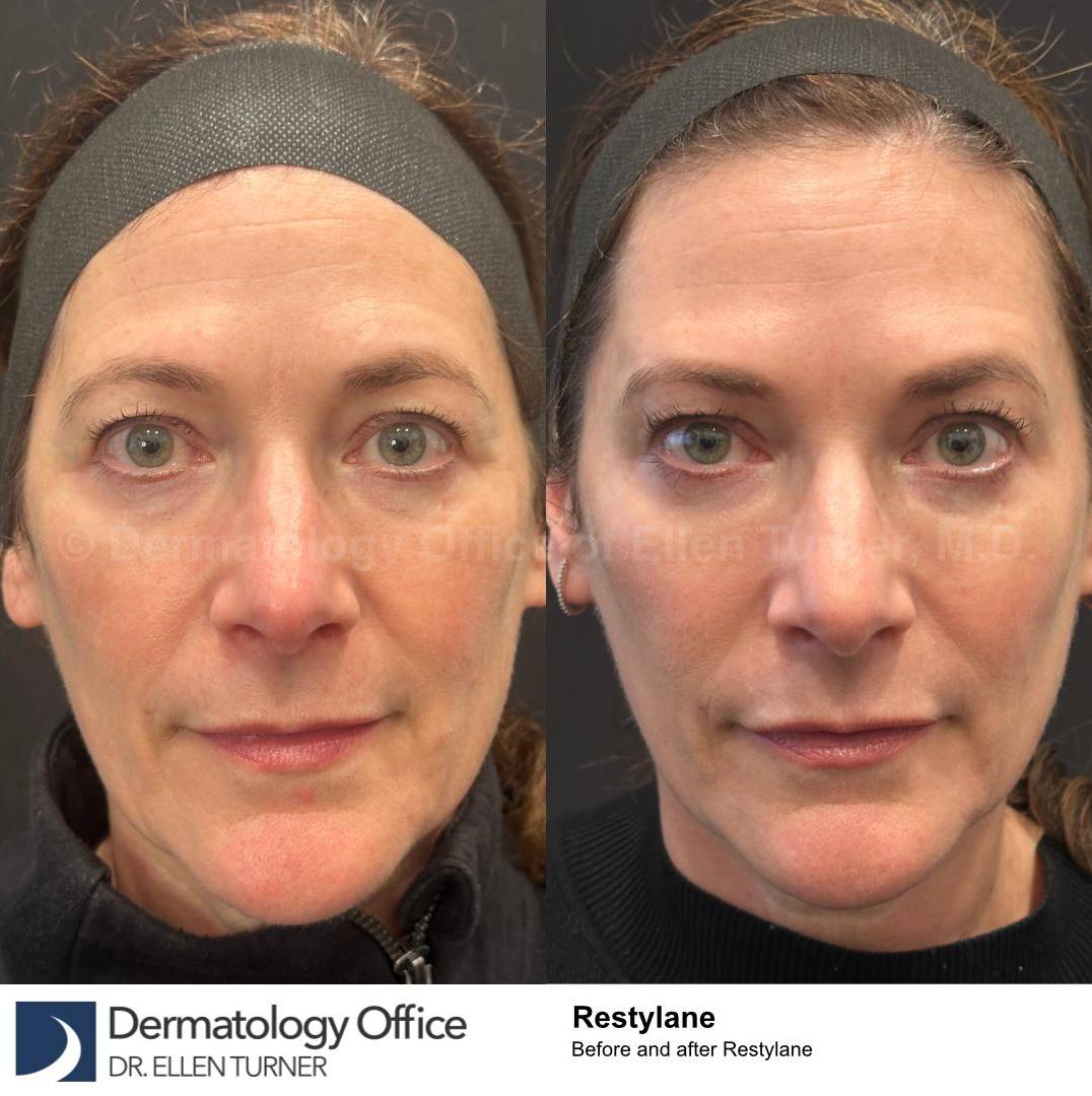 Restylane Before and After Case 10 