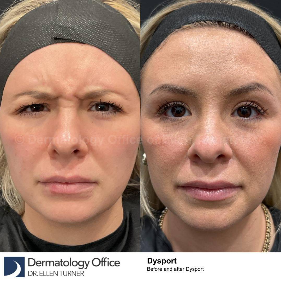 Dysport Before and after Case-2 