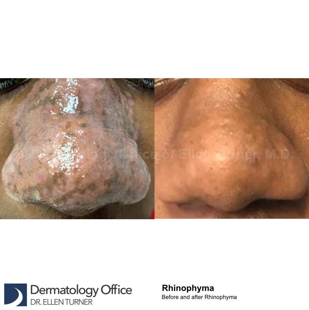 Laser Resurfacing Case-2 