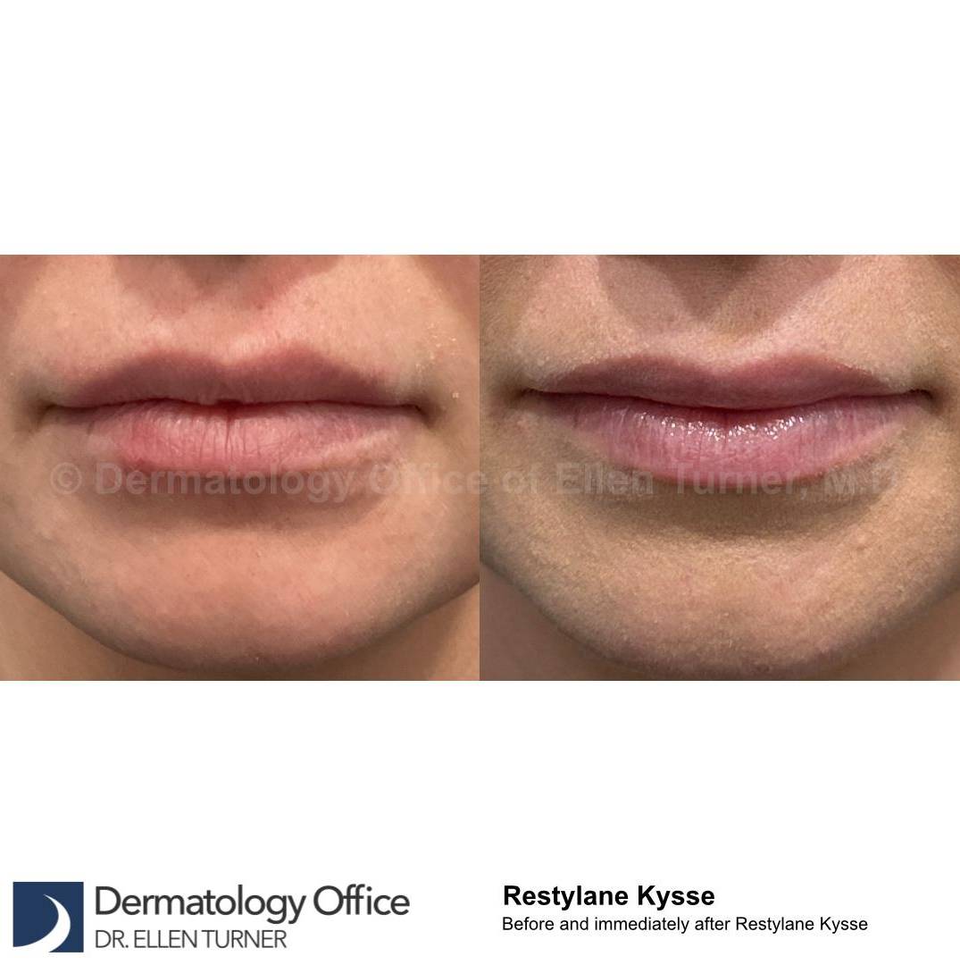 Restylane Before and After Case 21 