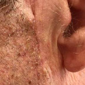 Skin Cancer Before and After Case 7 After