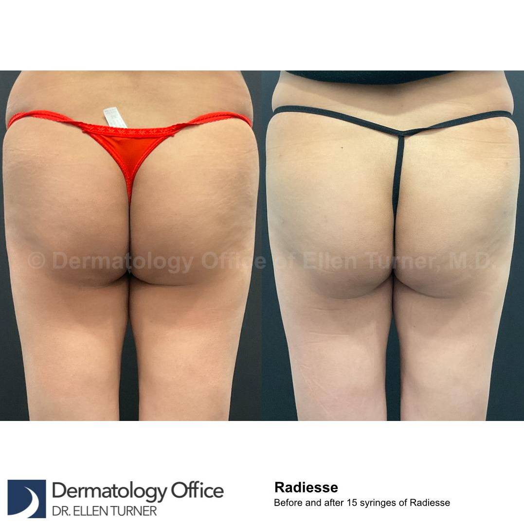 Radiesse Before and After Case 18 