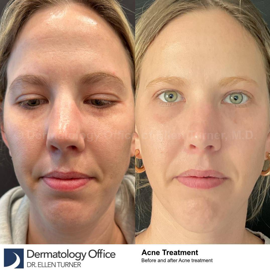 Acne Before and After Case-25 