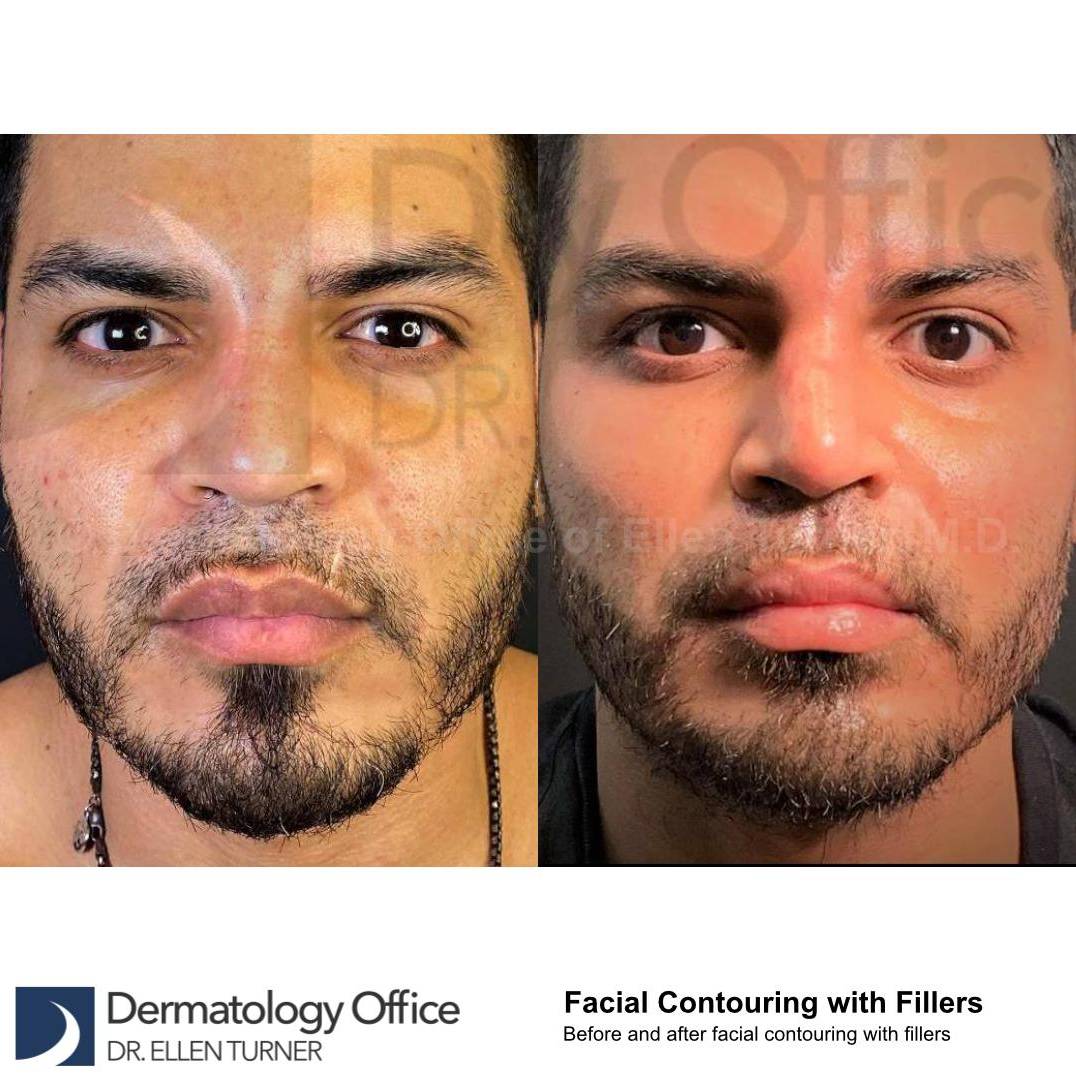 Facial Contouring with Fillers (20U Botox, 3RHA4, 2 Voluma) Case 1 