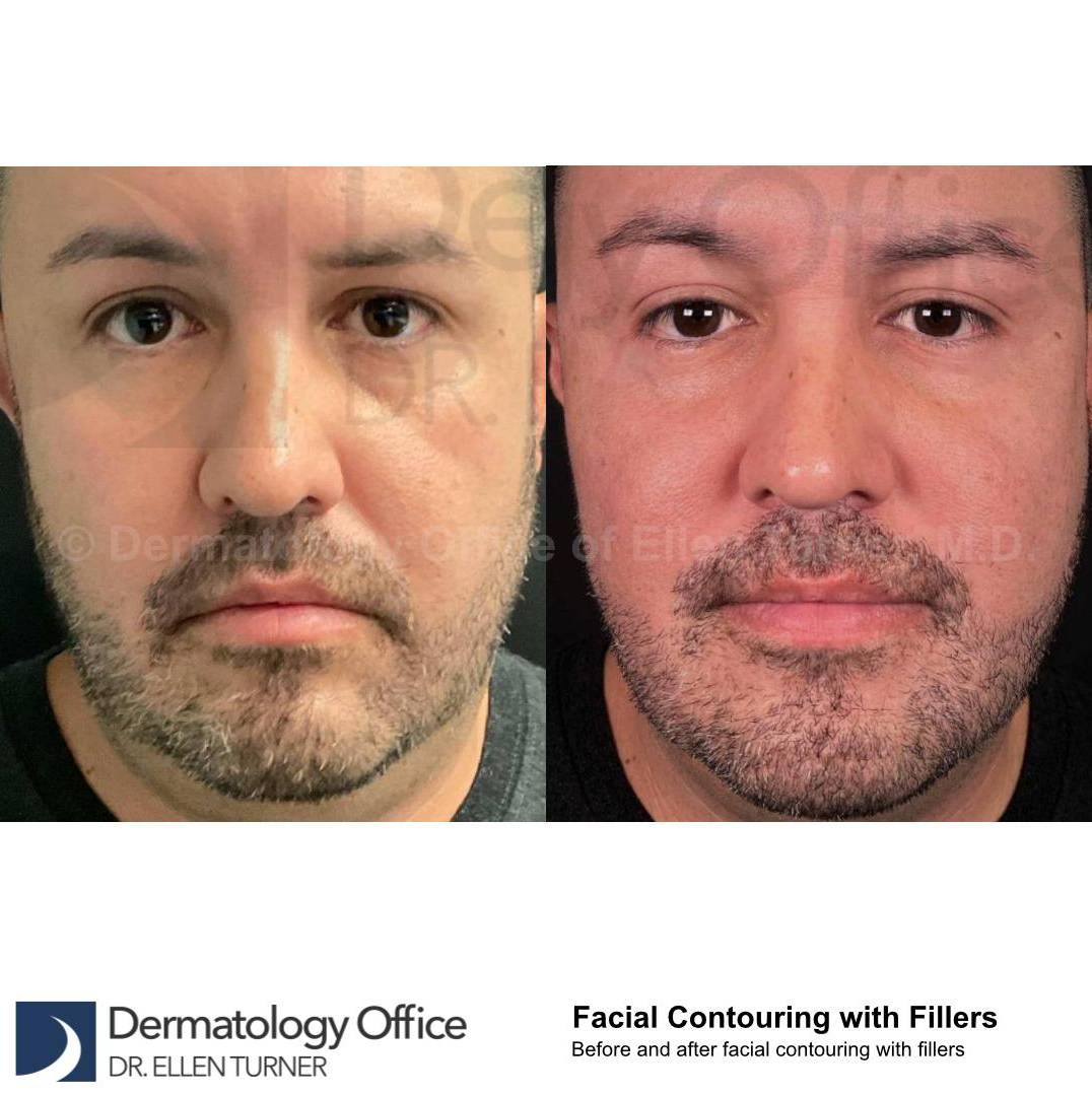 Facial Contouring with Filler (4 Voluma, 1 Kybella) Case 3 