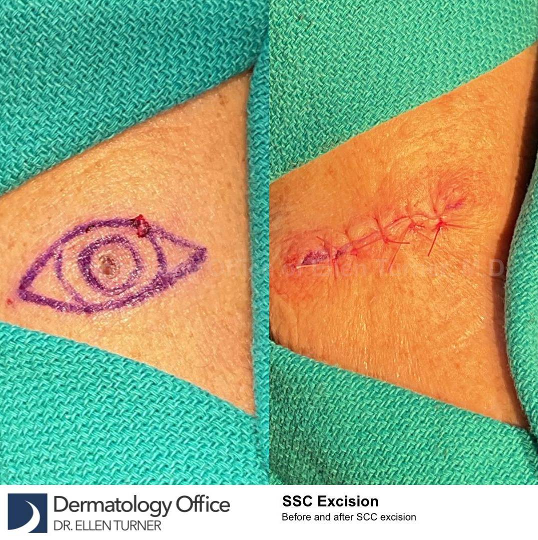 Skin Cancer (Excision) Case-92 