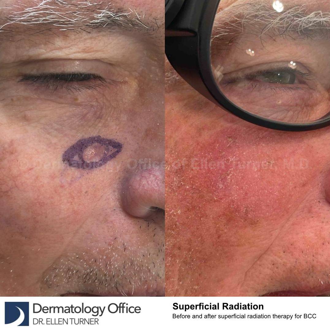 SRT-100 Before and After Case 13 