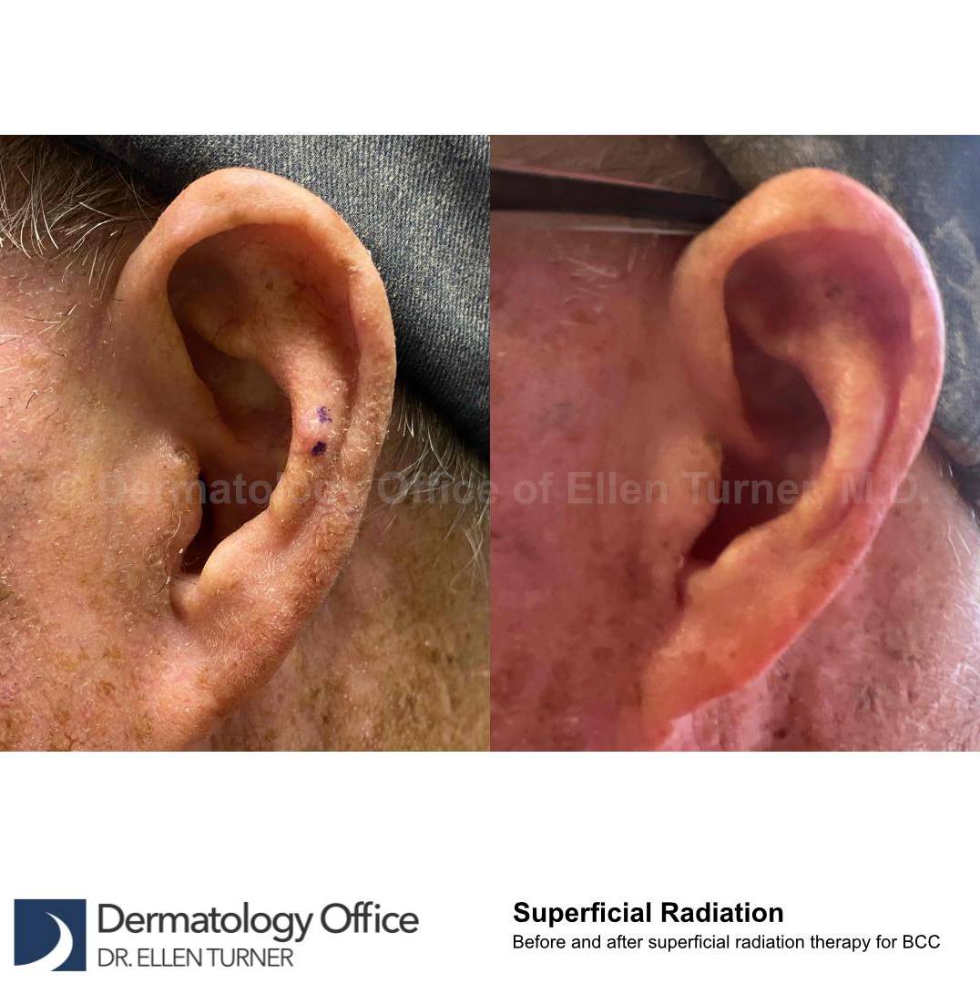 SRT-100 Before and After Case 15 