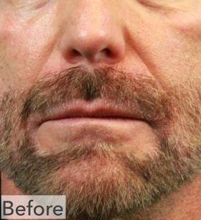 Seborrheic Dermatitis Before and After Case 1 Before