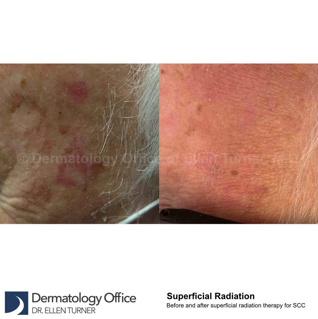 SRT-100 Before and After Case 30 