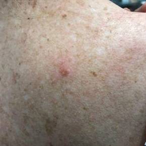 Shingles Before and After Case 1 Before