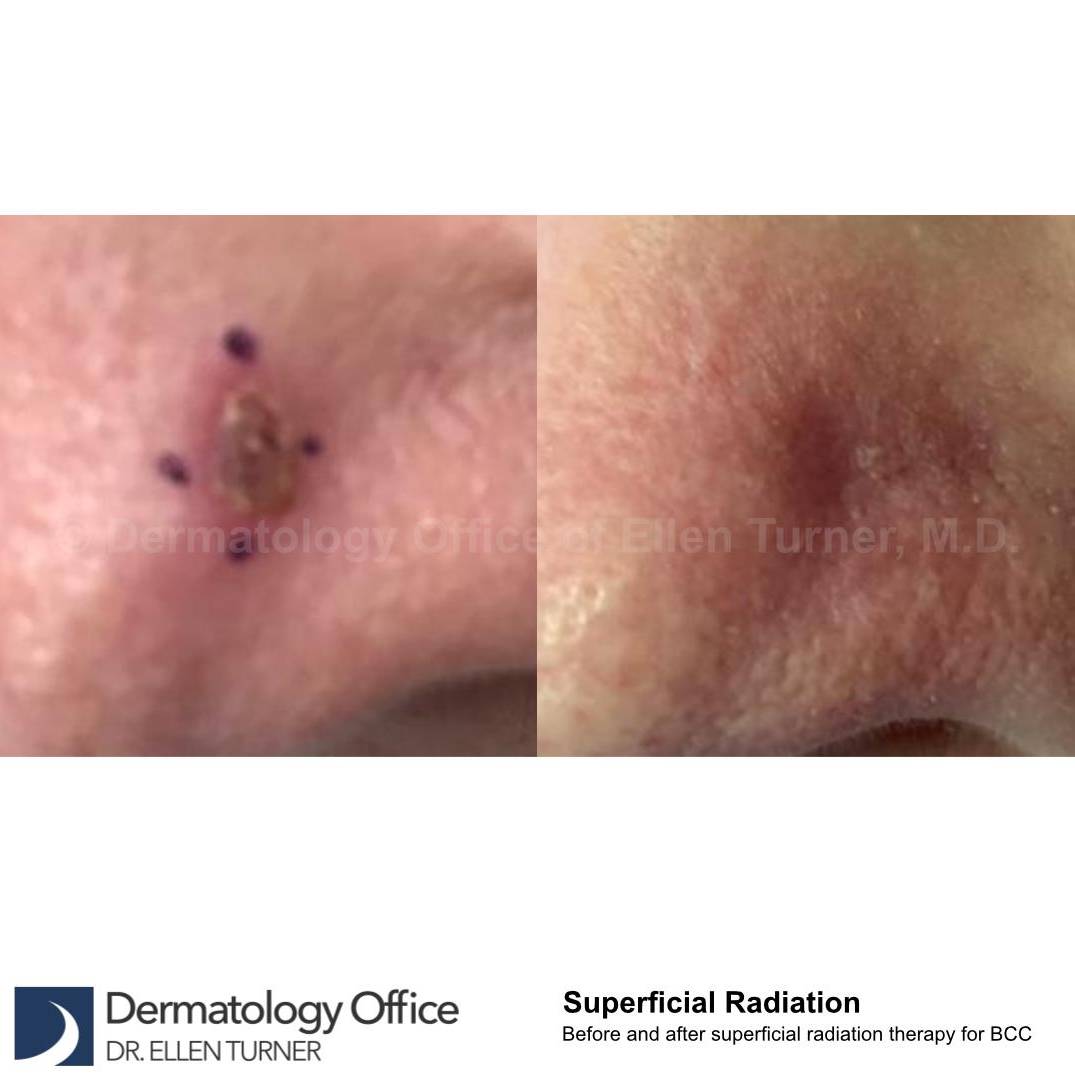 SRT-100 Before and After Case 37 