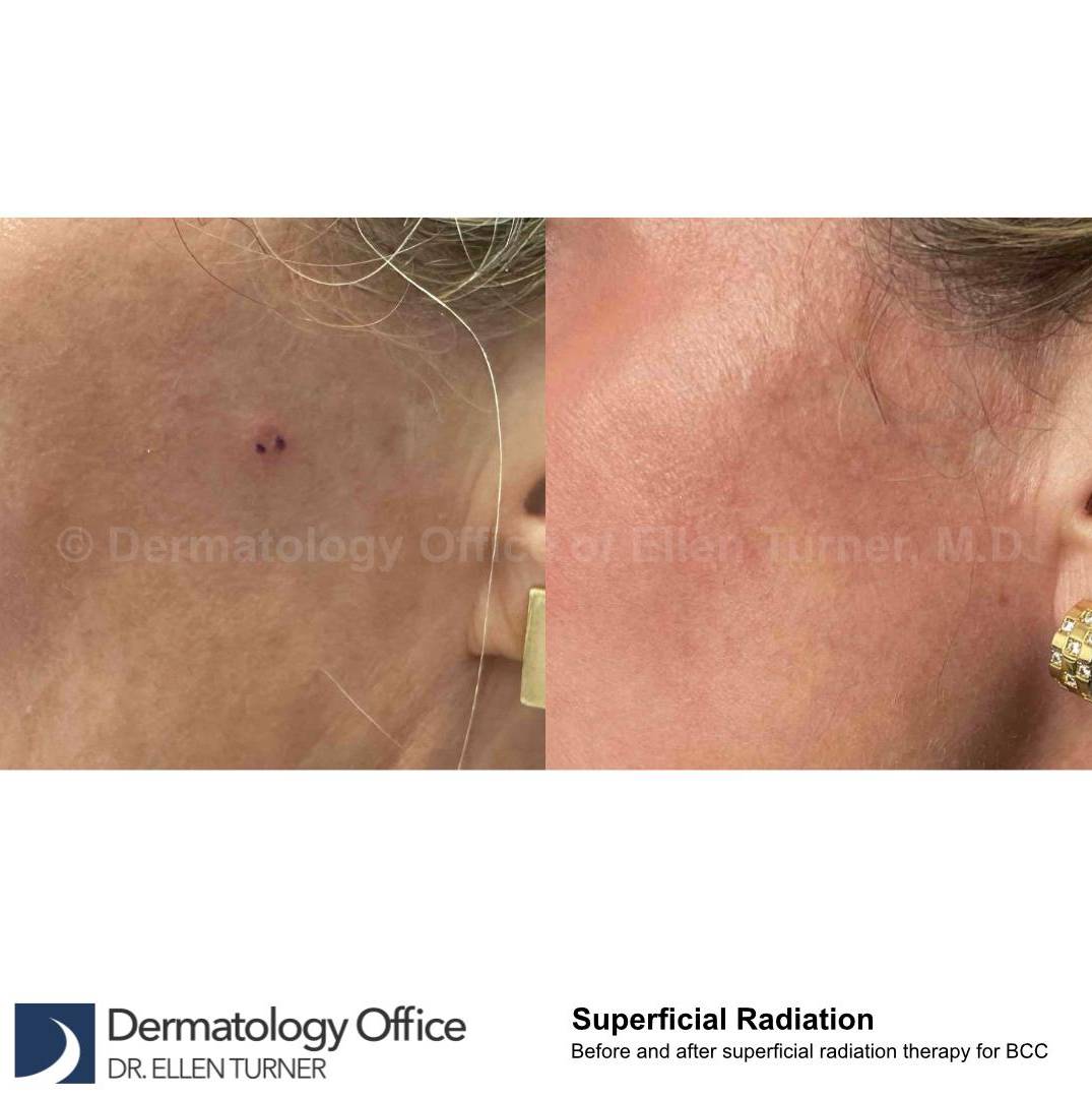 SRT-100 Before and After Case 38 