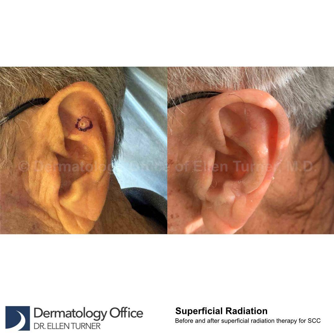SRT-100 Before and After Case 41 