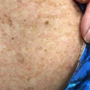 Shingles Before and After Case 1 After