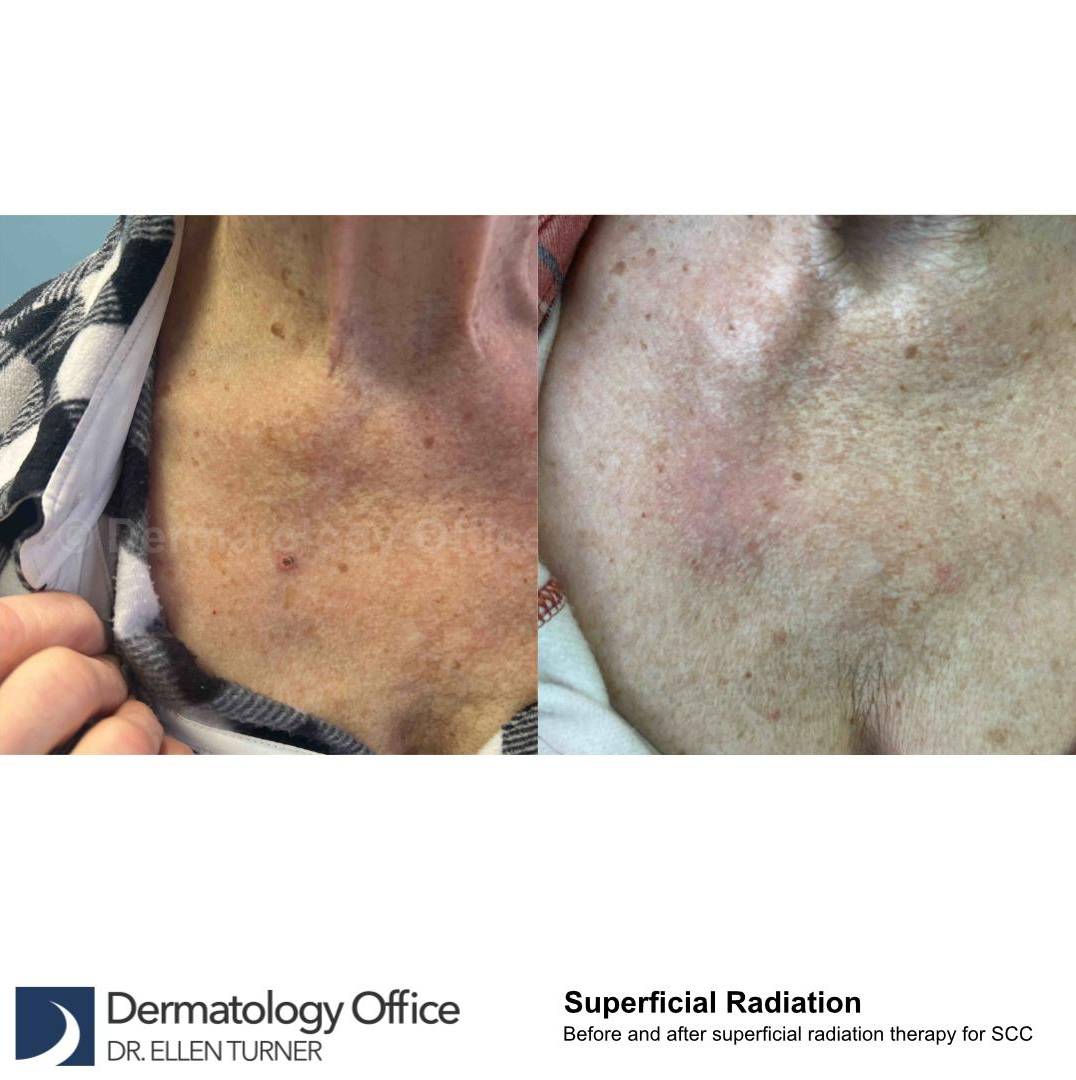 SRT-100 Before and After Case 49 