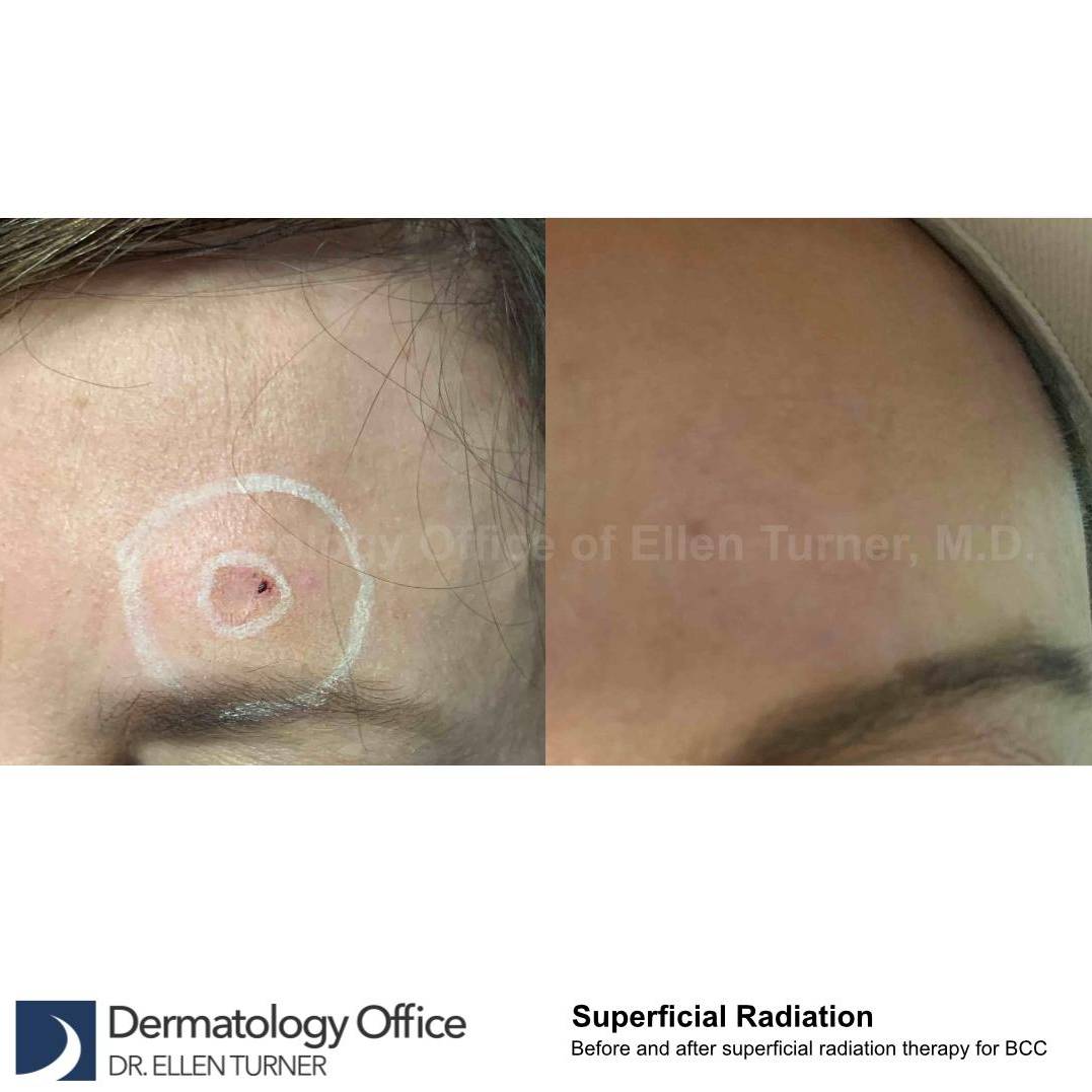 SRT-100 Before and After Case 50 