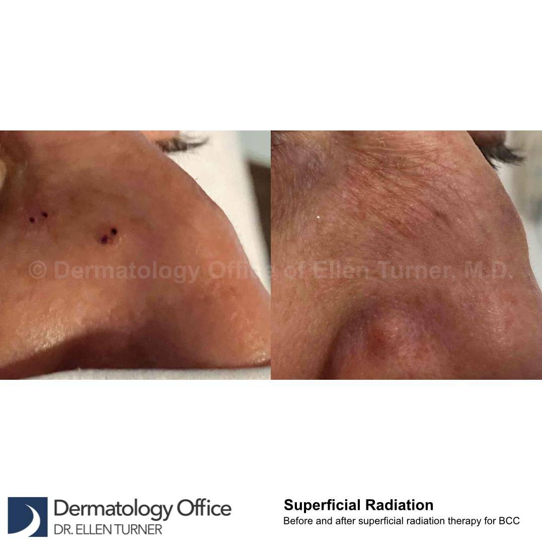SRT-100 Before and After Case 51 
