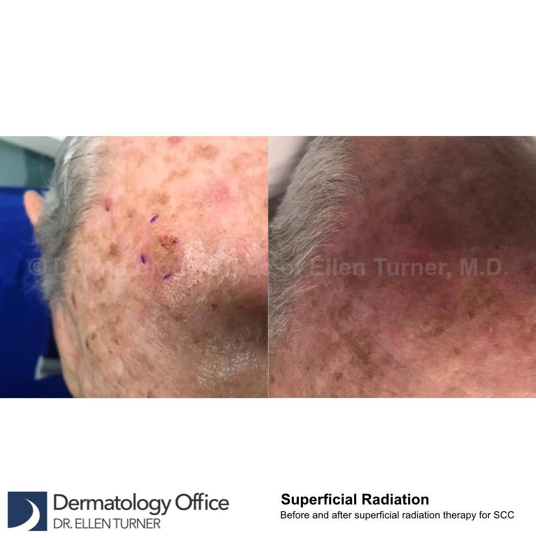SRT-100 Before and After Case 54 