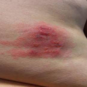 Shingles Before and After Case 2 Before