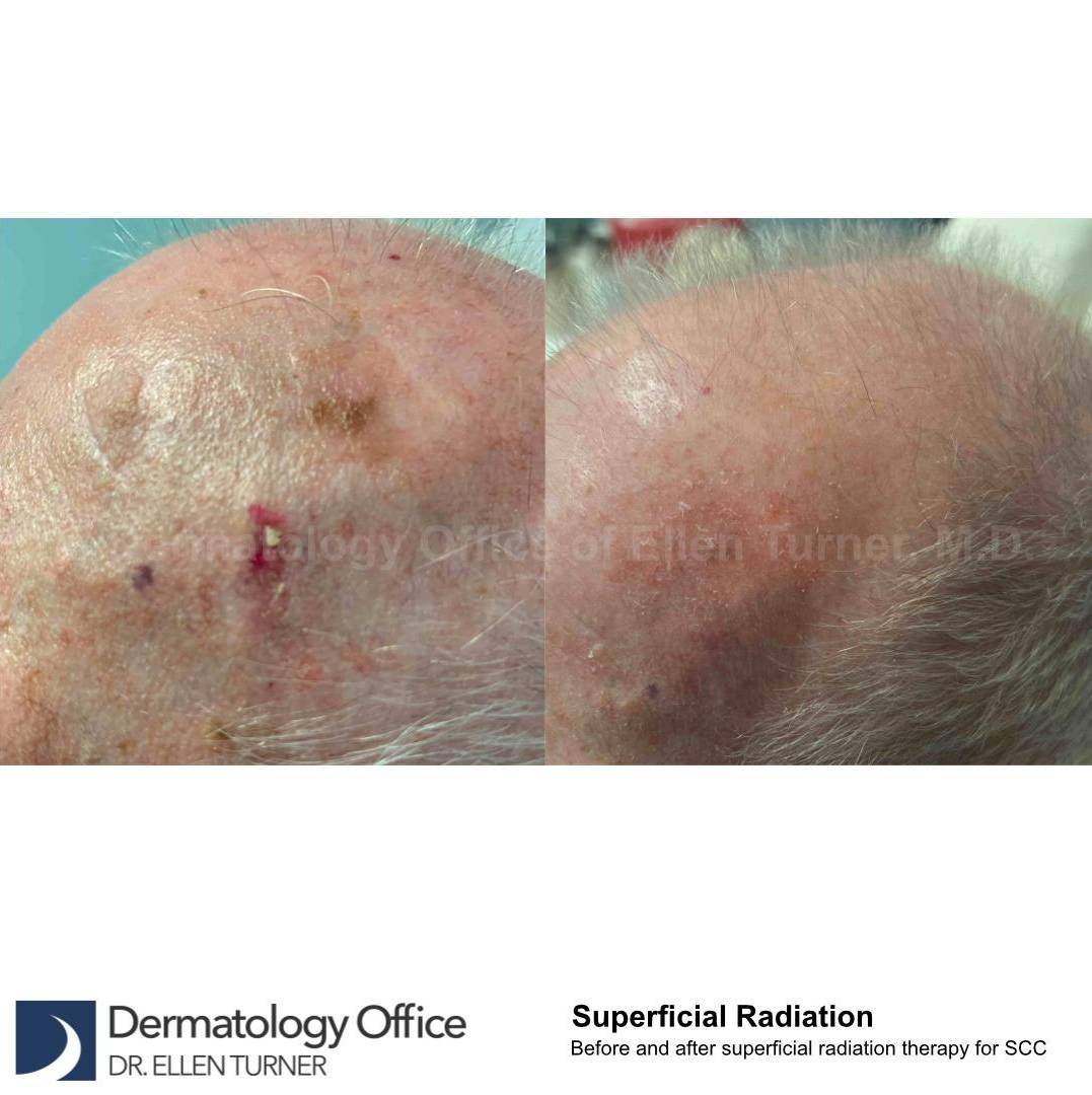 SRT-100 Before and After Case 55 