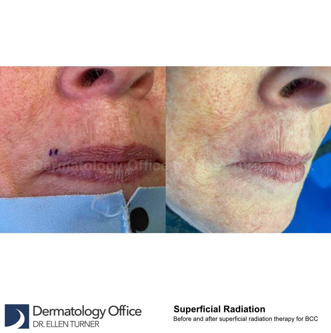 SRT-100 Before and After Case 56 