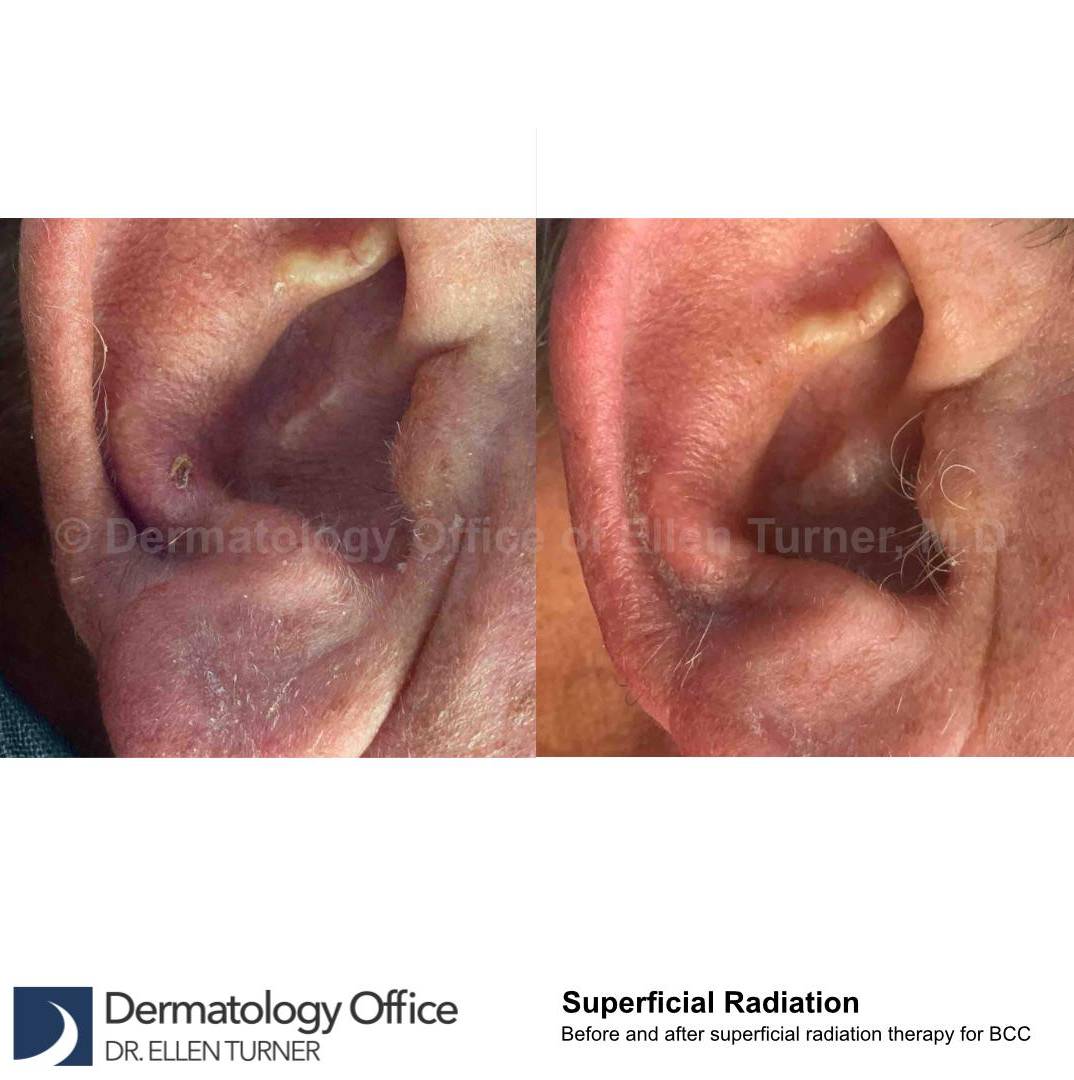 SRT-100 Before and After Case 64 