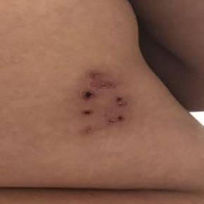 Shingles Before and After Case 2 After