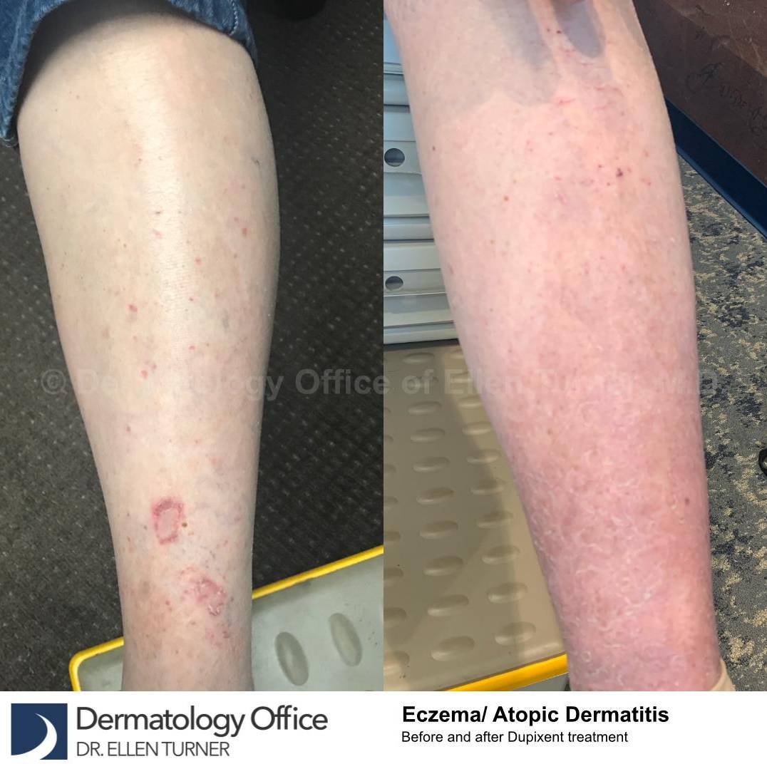 Eczema/Atopic Dermatitis Case 37 