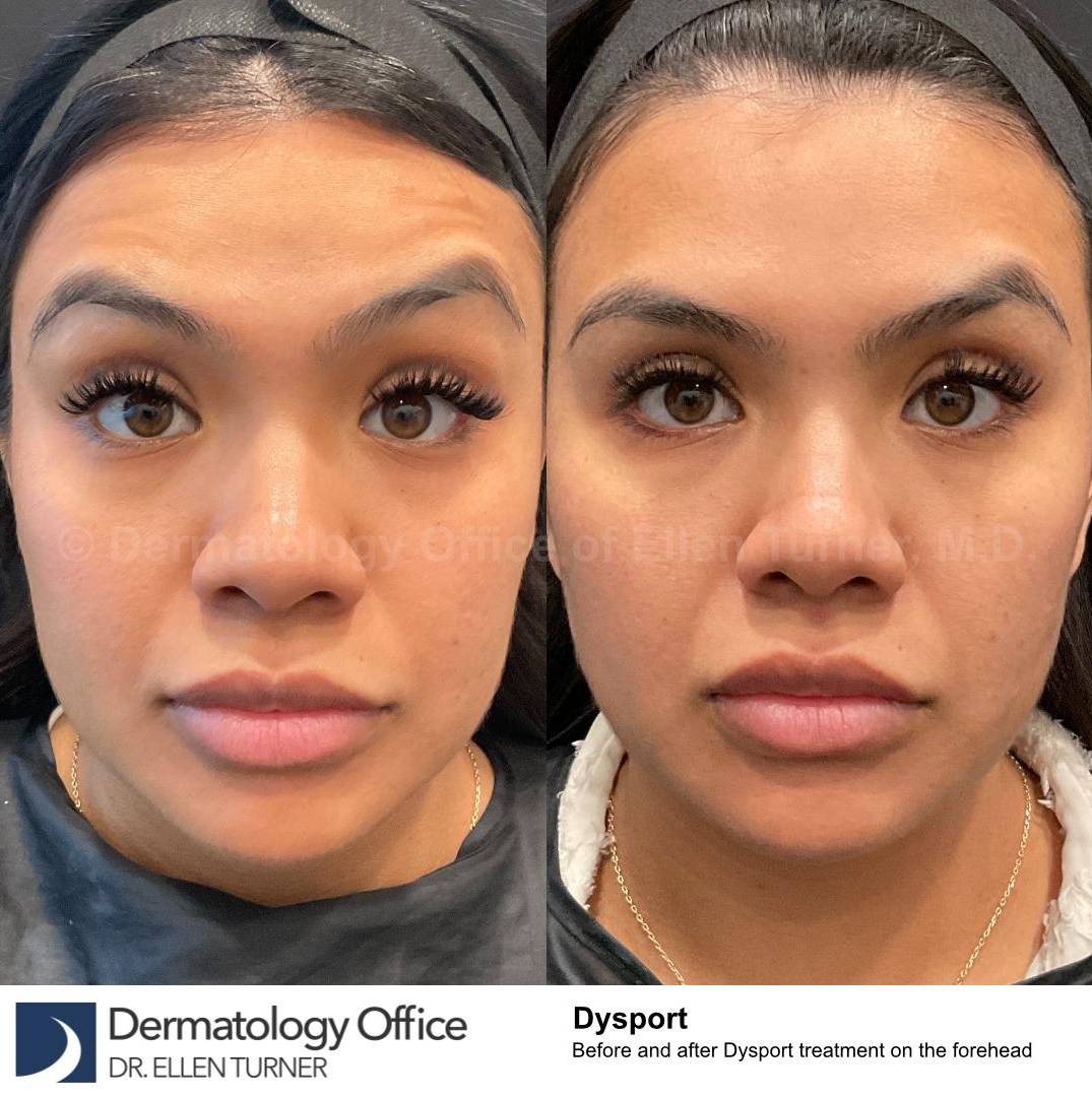 Dysport Before and after Case-3 