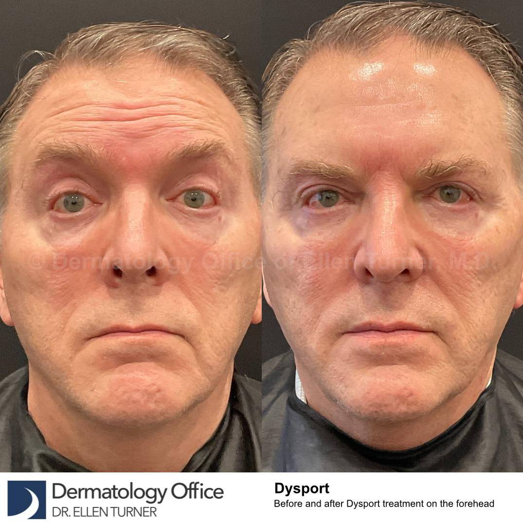 Dysport Before and after Case-4 